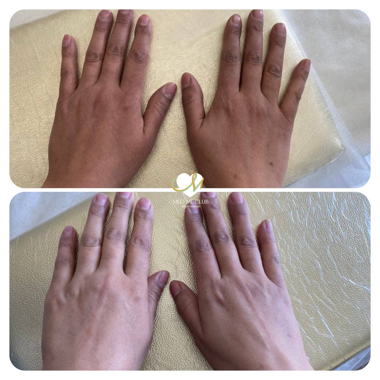 جوانسازی پوست دست در Med Me Club