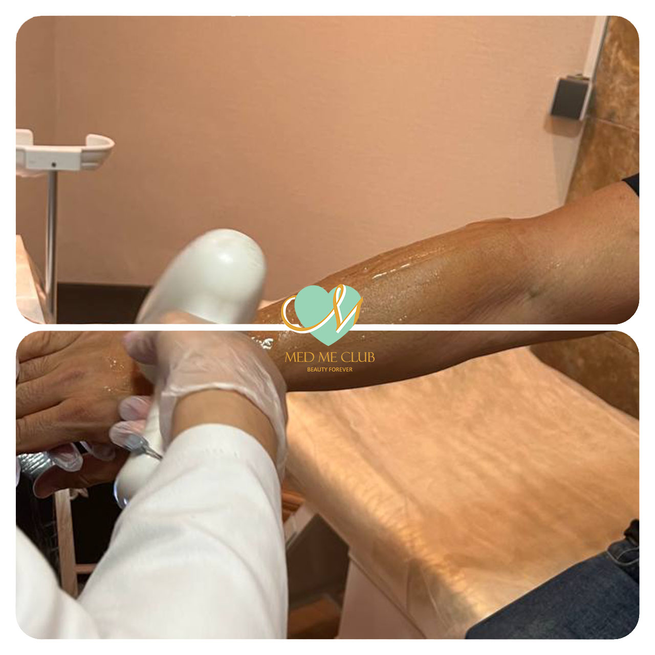لیزر موهای زائد در Med Me Club